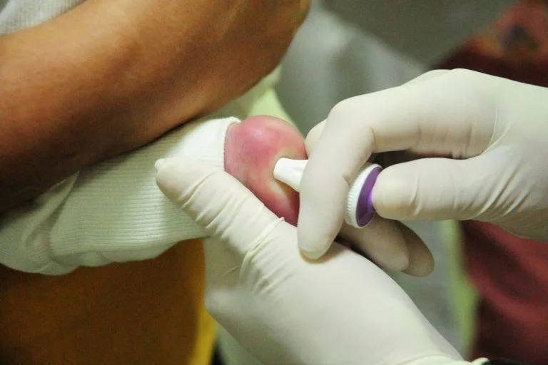 MT Hemocentro atende 599 pacientes com a doença falciforme