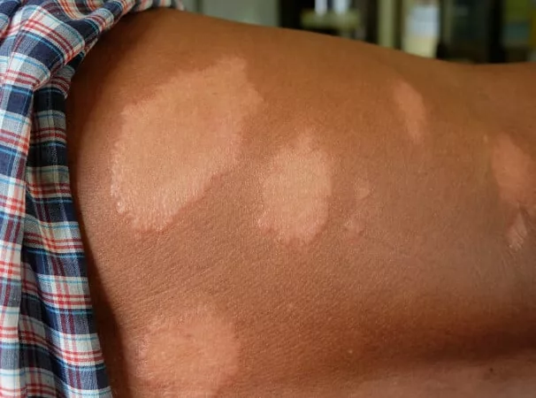 Prefeitura de Cuiabá intensifica ações de conscientização e combate à hanseníase